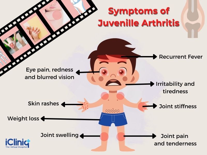 Juvenile Arthritis (Childhood Arthritis) | Causes | Types | Symptoms ...